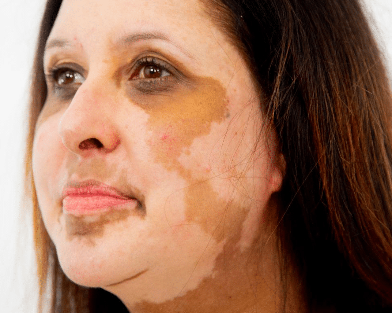 CellDerma Face Close Up Skin depigmentation Content Image