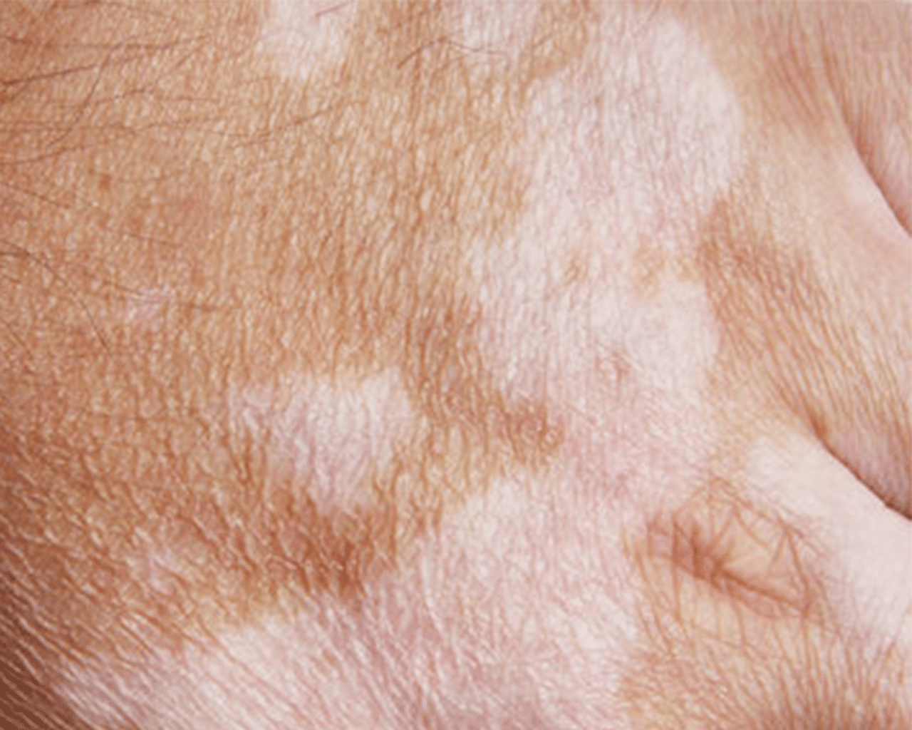 CellDerma Hypo Close Up Skin Pigmentation Content Image