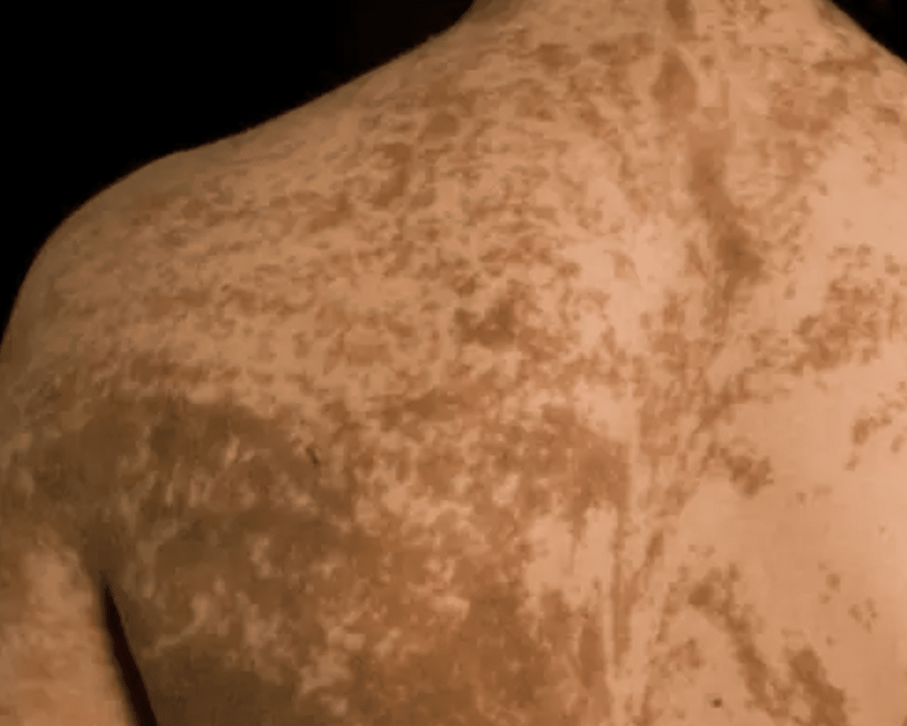 CellDerma Pigmentation on Back Human Close Up Content Image