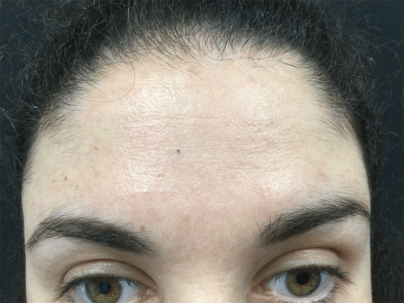 CellDerma Female Forehead After Pigment Correct Discolouration and Pigmentation Content Image
