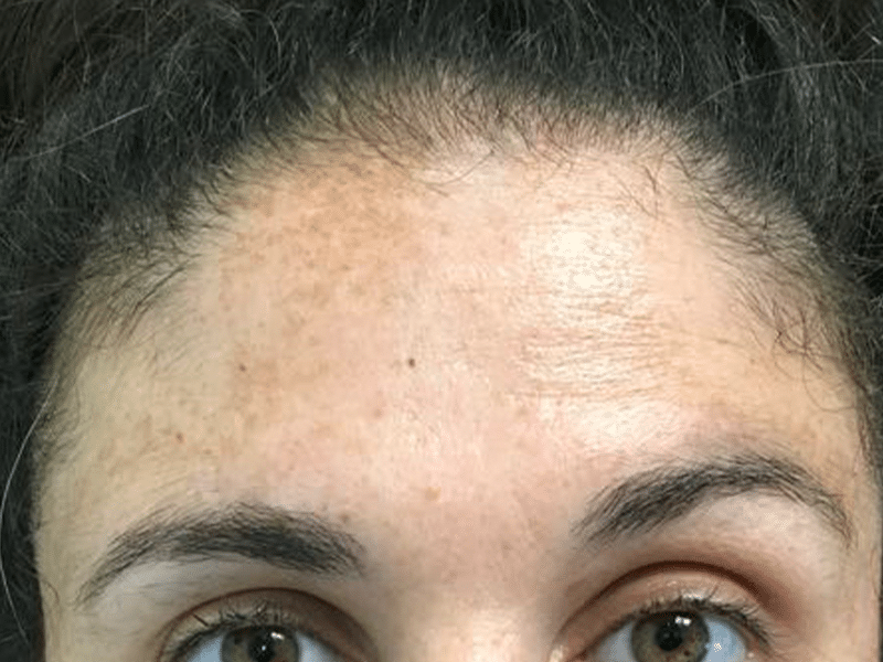 CellDerma Female Forehead Before Pigment Correct Discolouration and Pigmentation Content Image