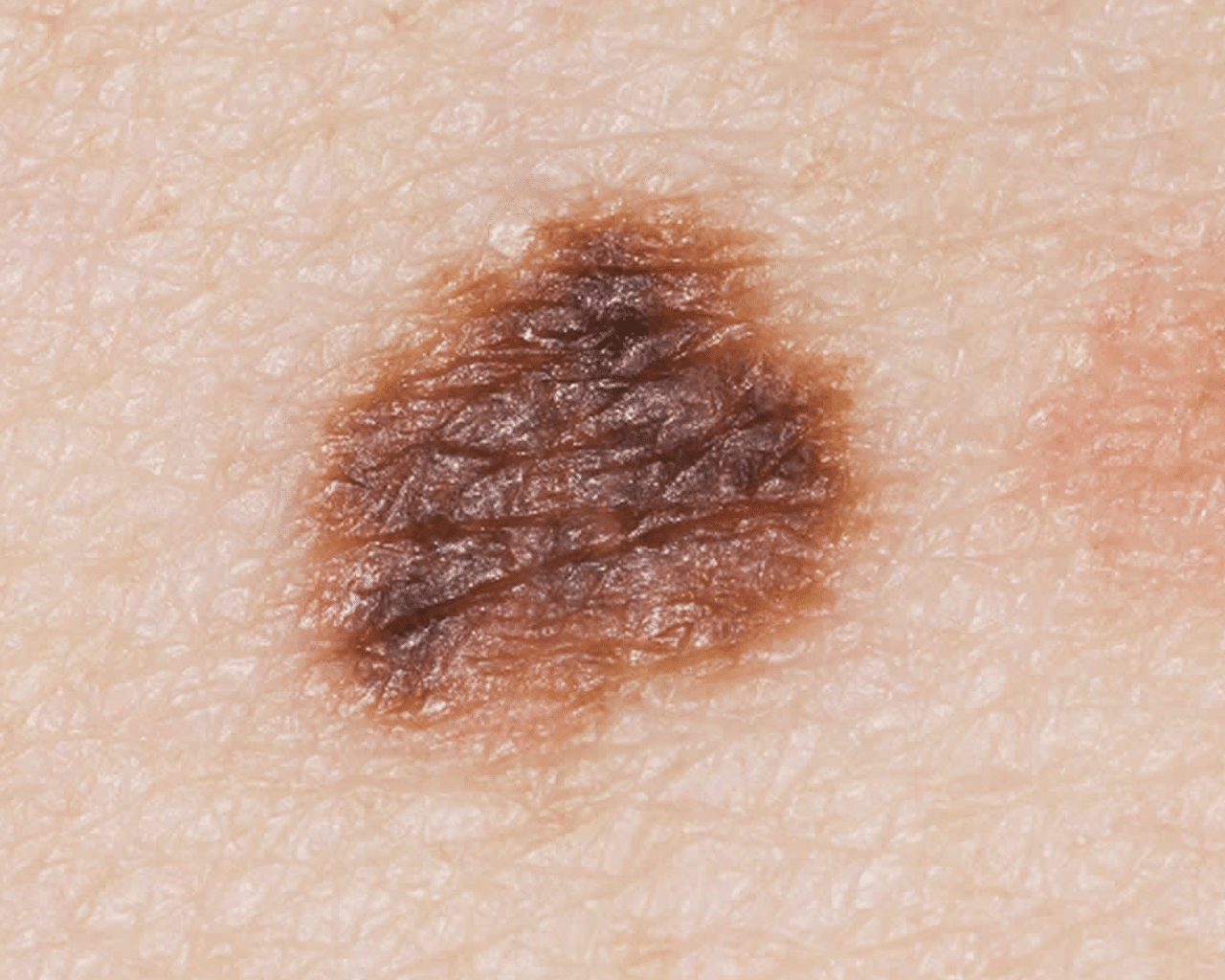 CellDerma Mole Close Up Content Image