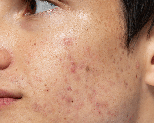 CellDerma Young Male Moderate Acne And Scarring Left Cheek Content Image