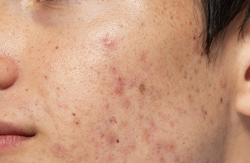 CellDerma Young Male Moderate Acne And Scarring Left Cheek Content Image