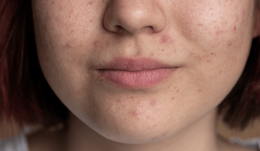 CellDerma Close Up Woman Lower Face Acne And Acne Scarring Mild Content Image