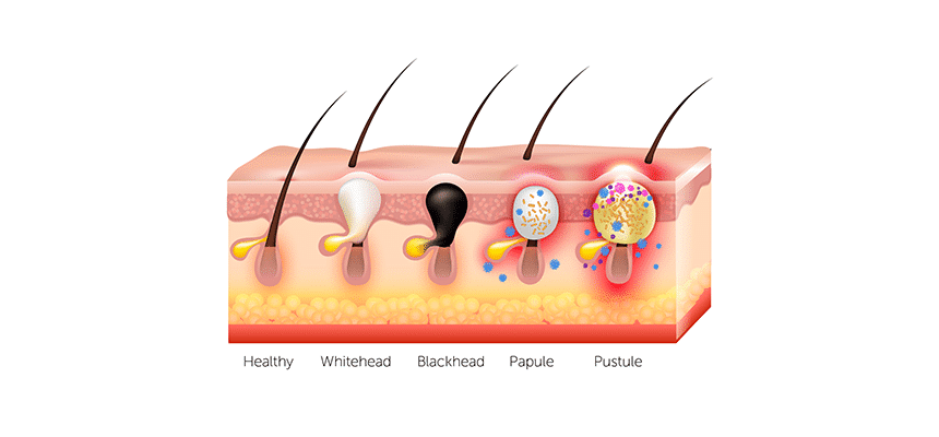 CellDerma Illustrated Scientific Diagram of Skin Layers Showing Acne Content Image