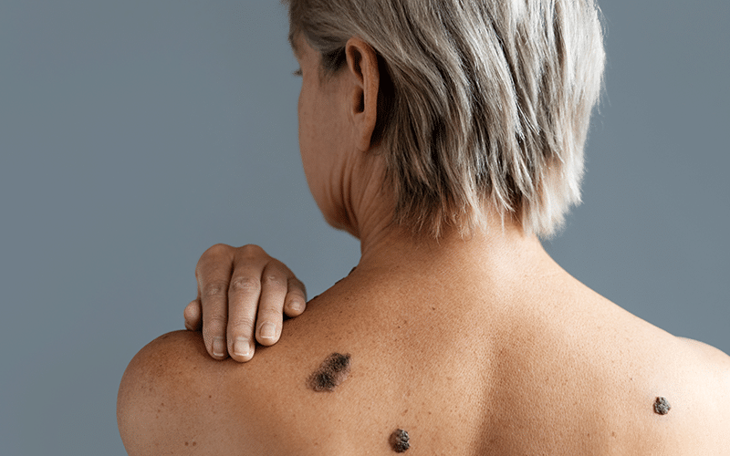 CellDerma Moles on Woman Back Content Image