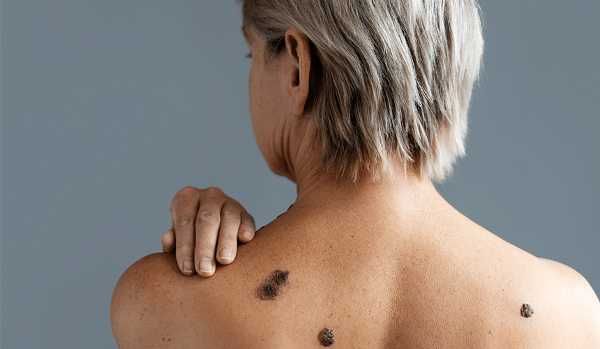 CellDerma Moles on Woman Back Content Image