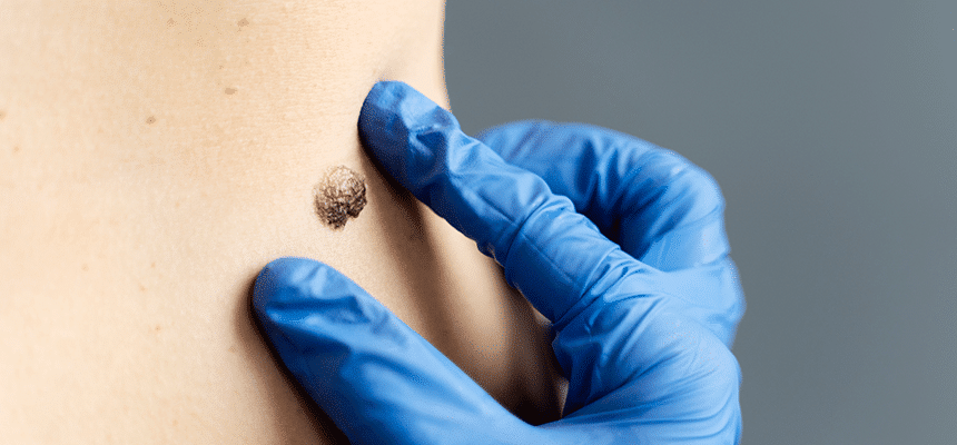 CellDerma Mole Close Up Hand Check Up Content Image