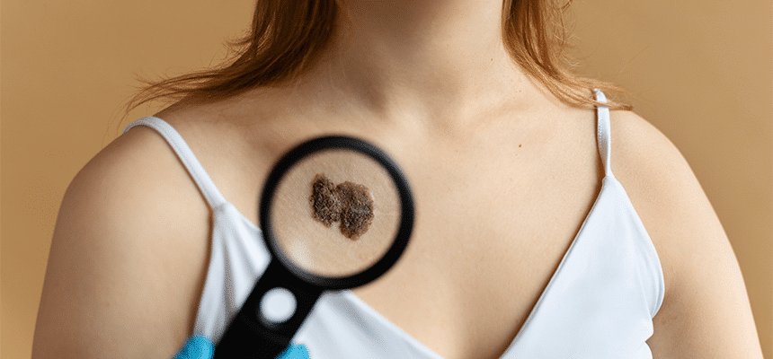 CellDerma Moles on Woman Décolletage Magnifying Glass Content Image