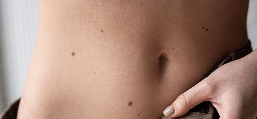 CellDerma Ladies Torso Moles Close Up Content Image