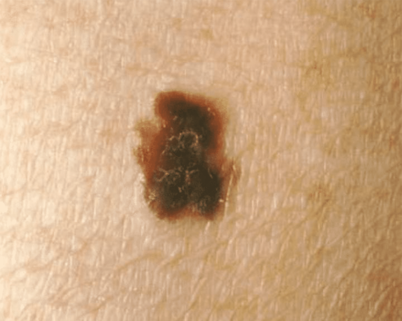 CellDerma Mole Close Up Content Image