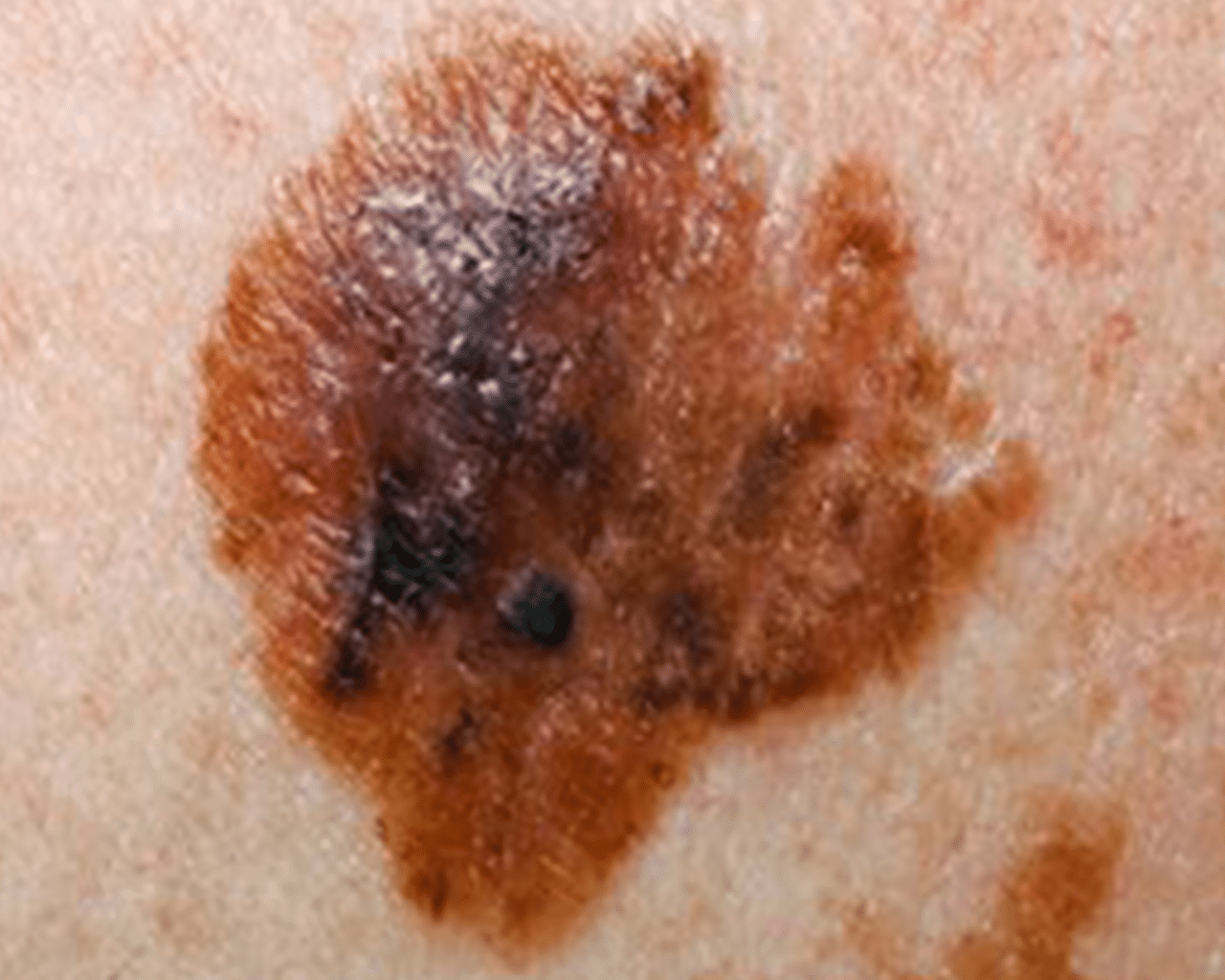 CellDerma Mole Close Up Content Image