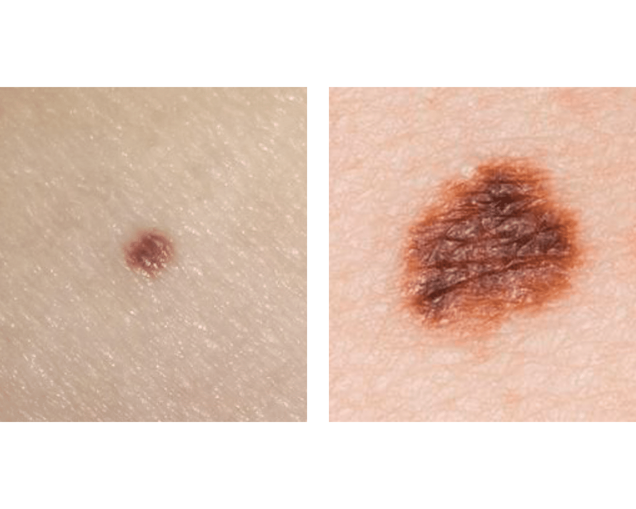 CellDerma Mole Close Up Content Image