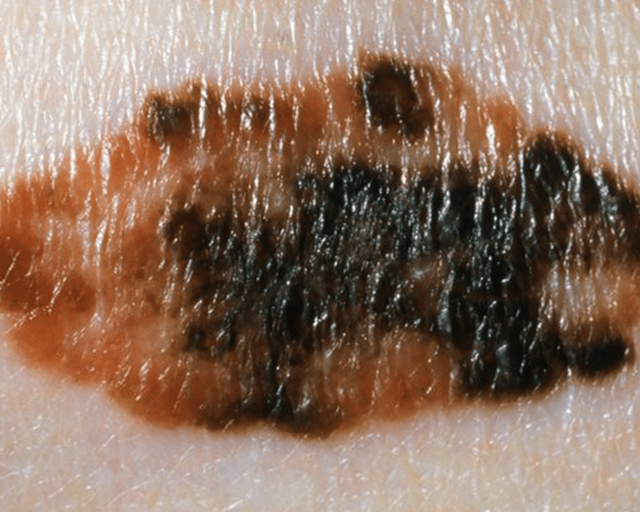 CellDerma Mole Close Up Content Image