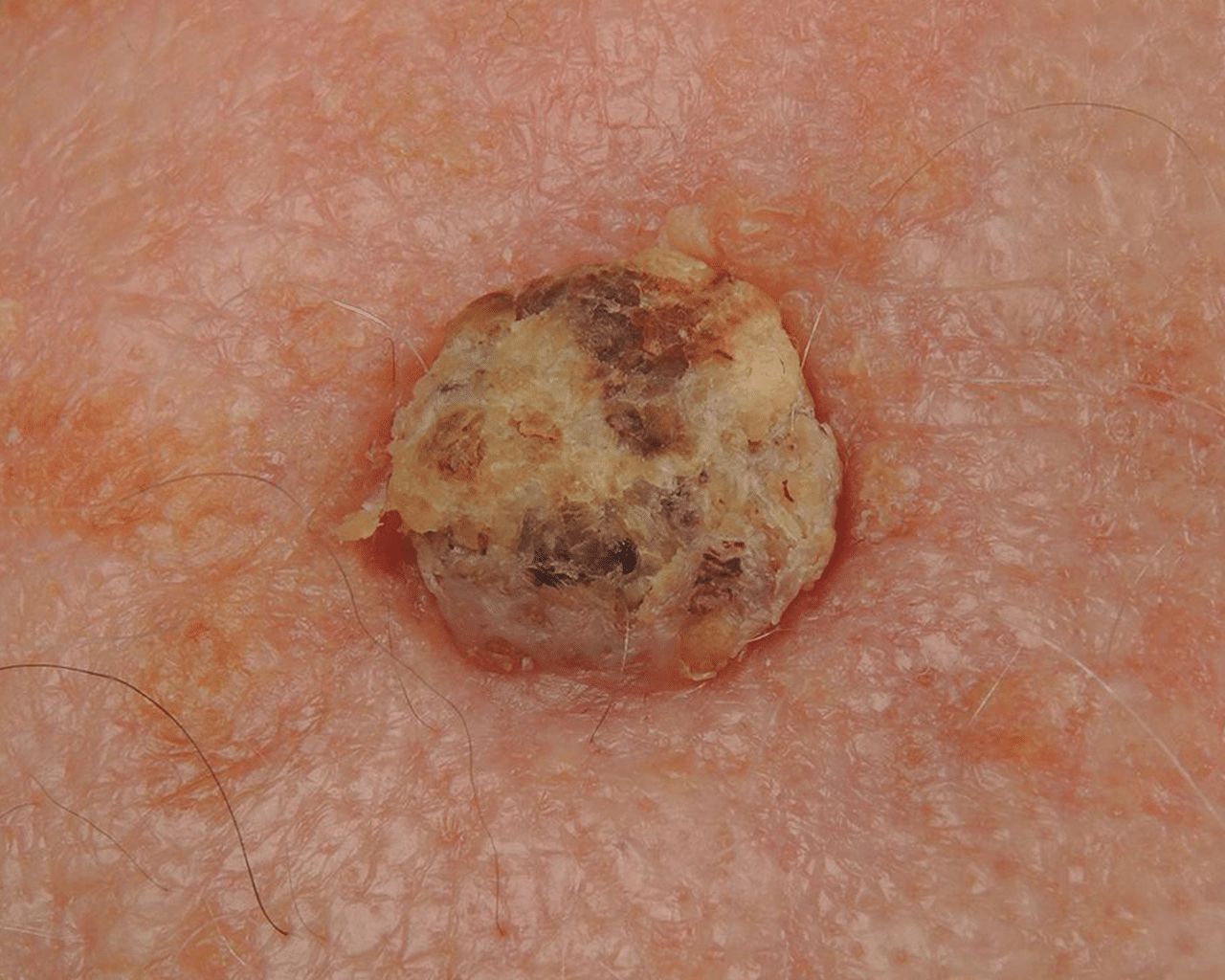 CellDerma Mole Close Up Content Image