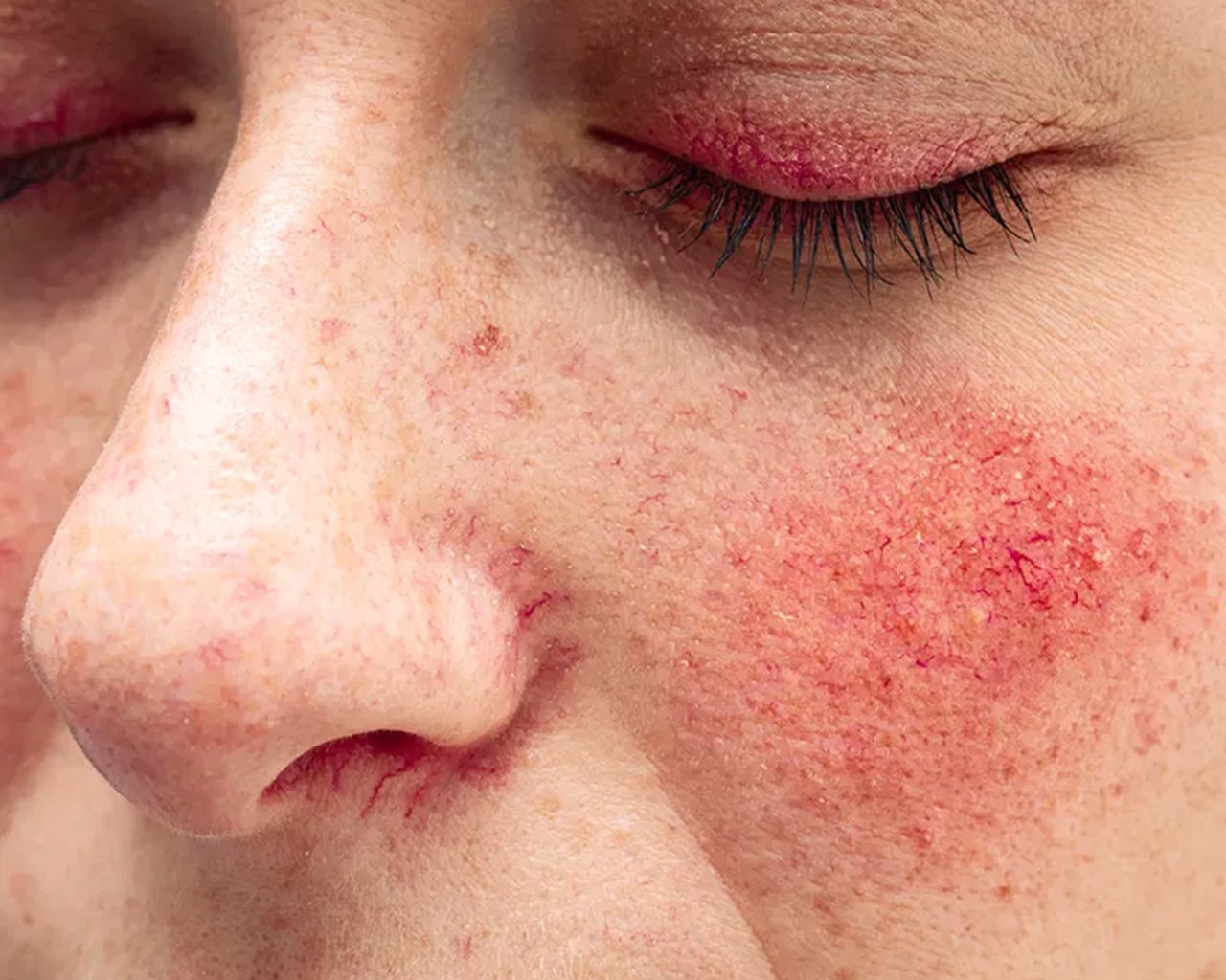 CellDerma Rosacea Close Up Model Face Content Image