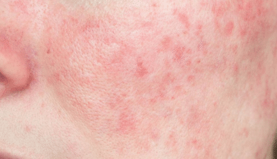 CellDerma Rosacea Close Up Model Face Content Image