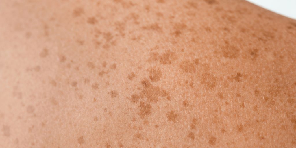 CellDerma Pigmentation Skin Close Up Content Image