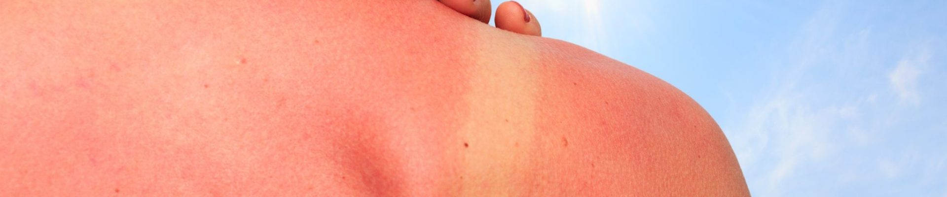 CellDerma Sun Damage Sun Sun Burn Content Image