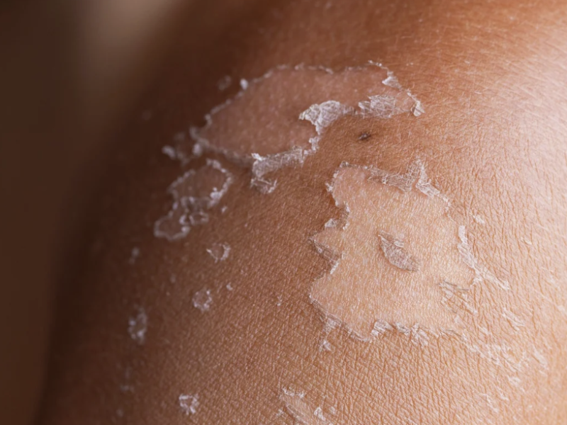 CellDerma Sun Damage Skin Close Up Content Image