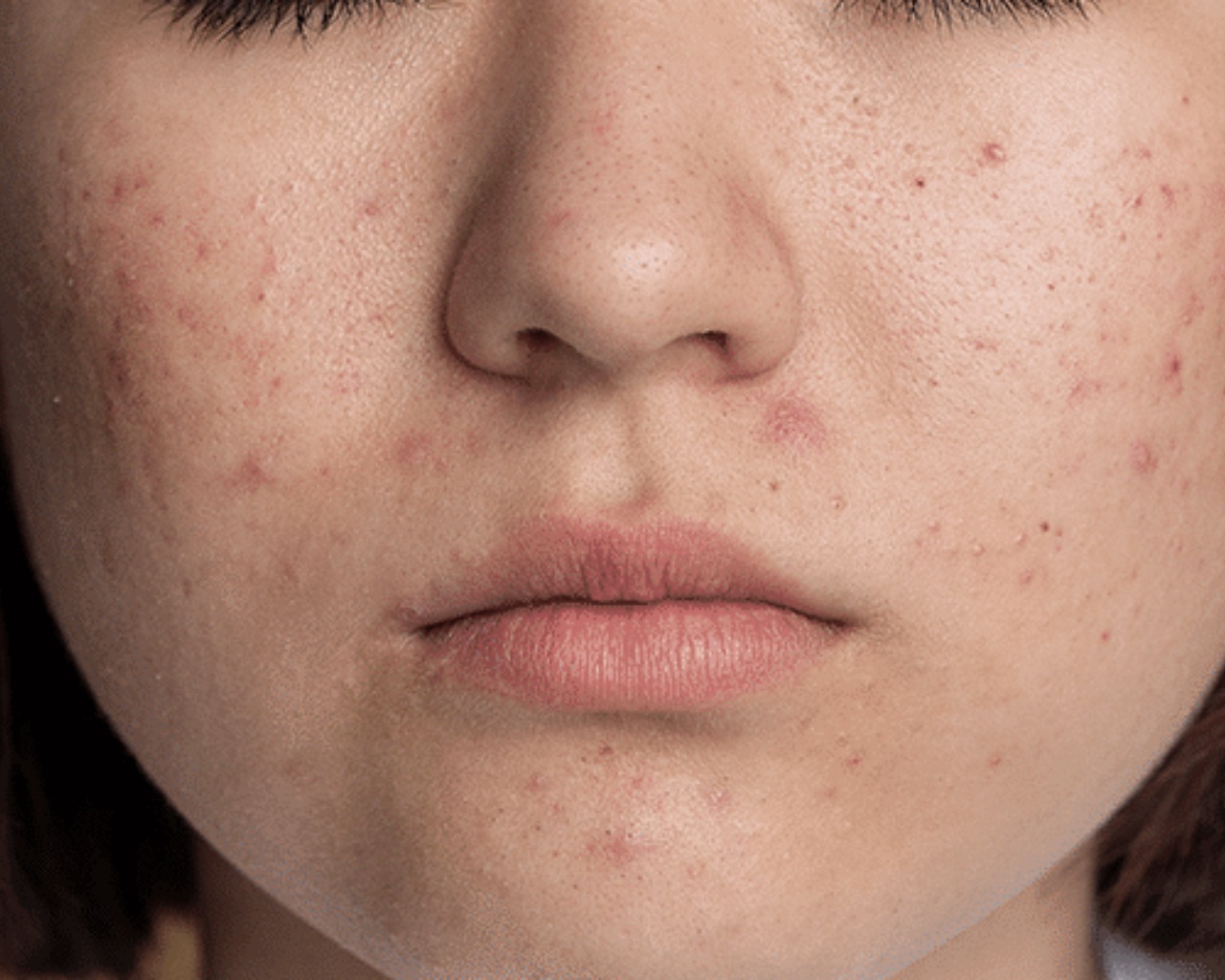 CellDerma Acne Skin Close Up Content Image