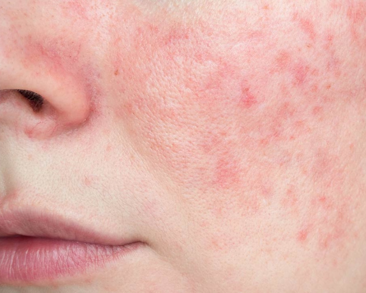 CellDerma Rosacea Close Up Skin Content Image