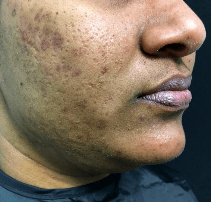 Acne after Retin-ace patient case study