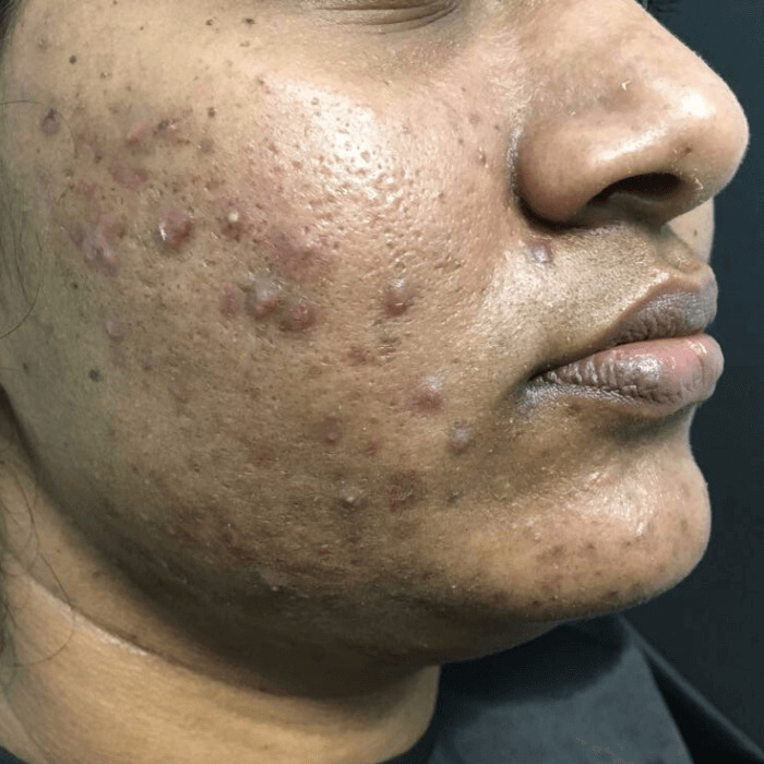 Acne before Retin-ace patient case study