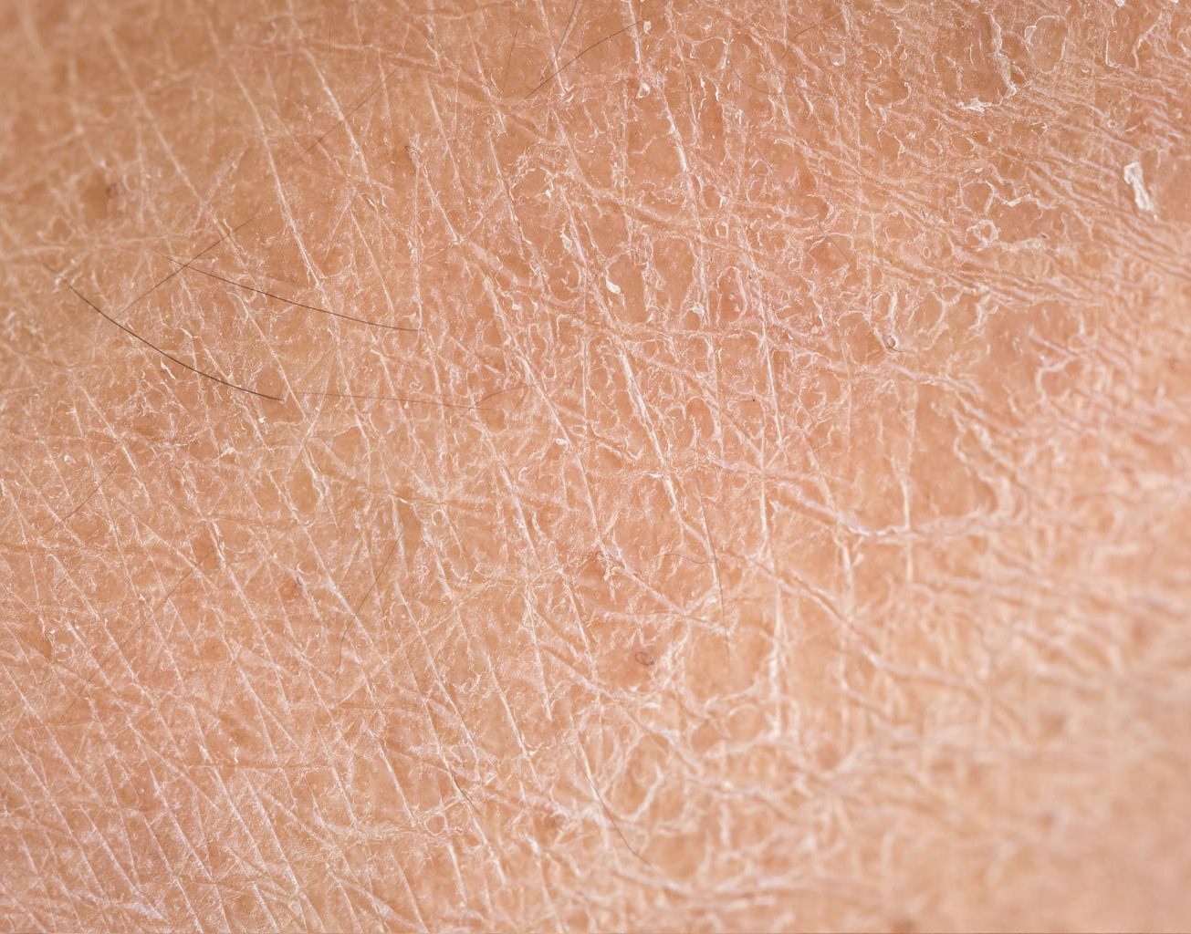 Close up on dry skin patch
