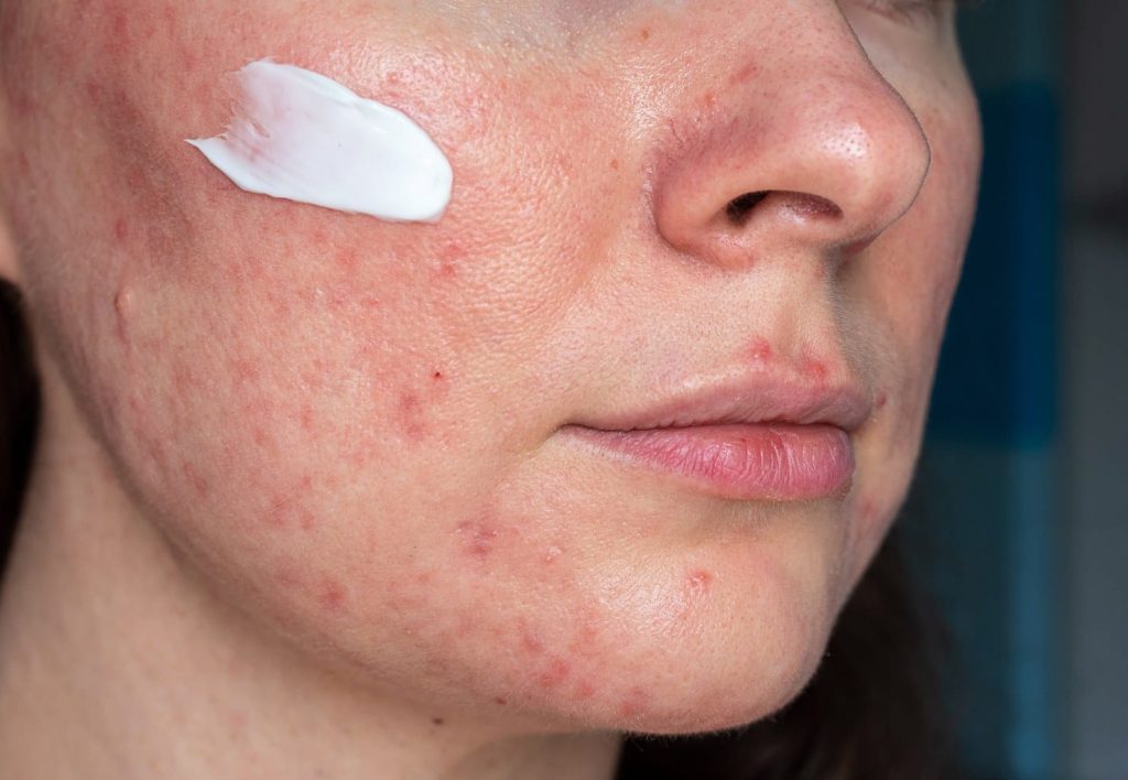 cream on cheek of model with rosacea