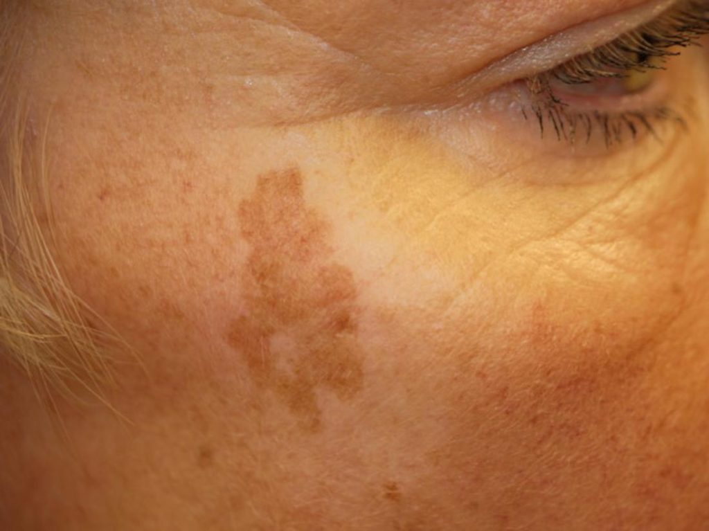 close up of large age spot sun spot on face