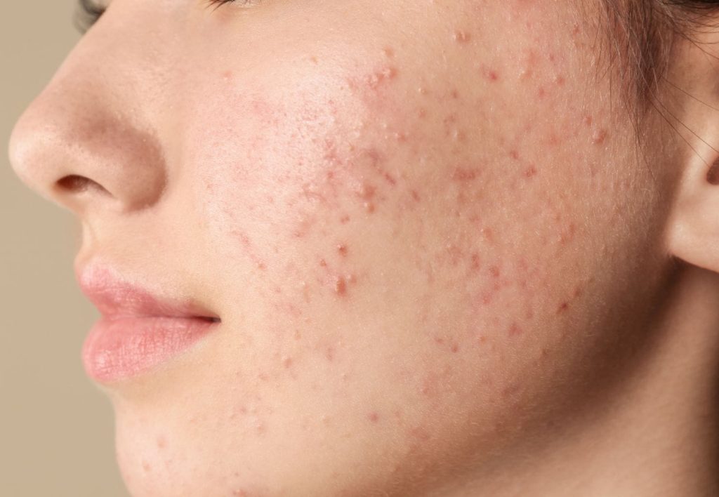 acne on cheek