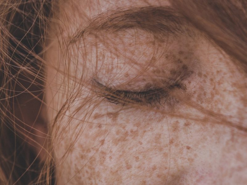pigmentation freckles on face