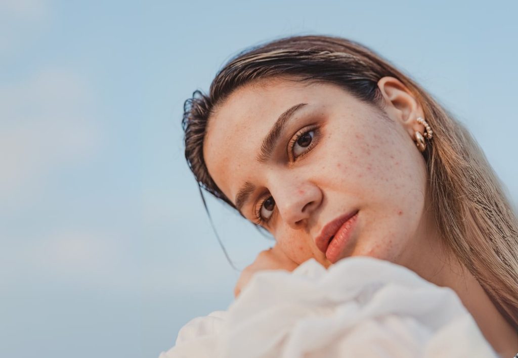 acne summer woman